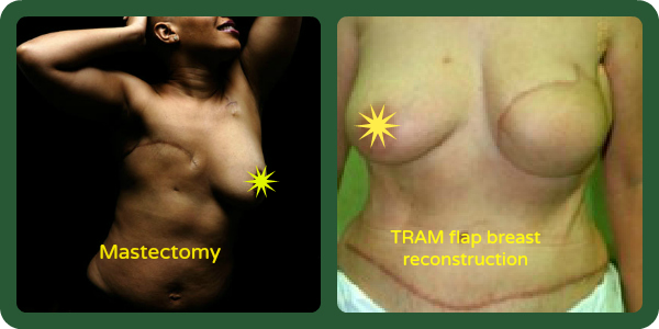 mastectomy photo