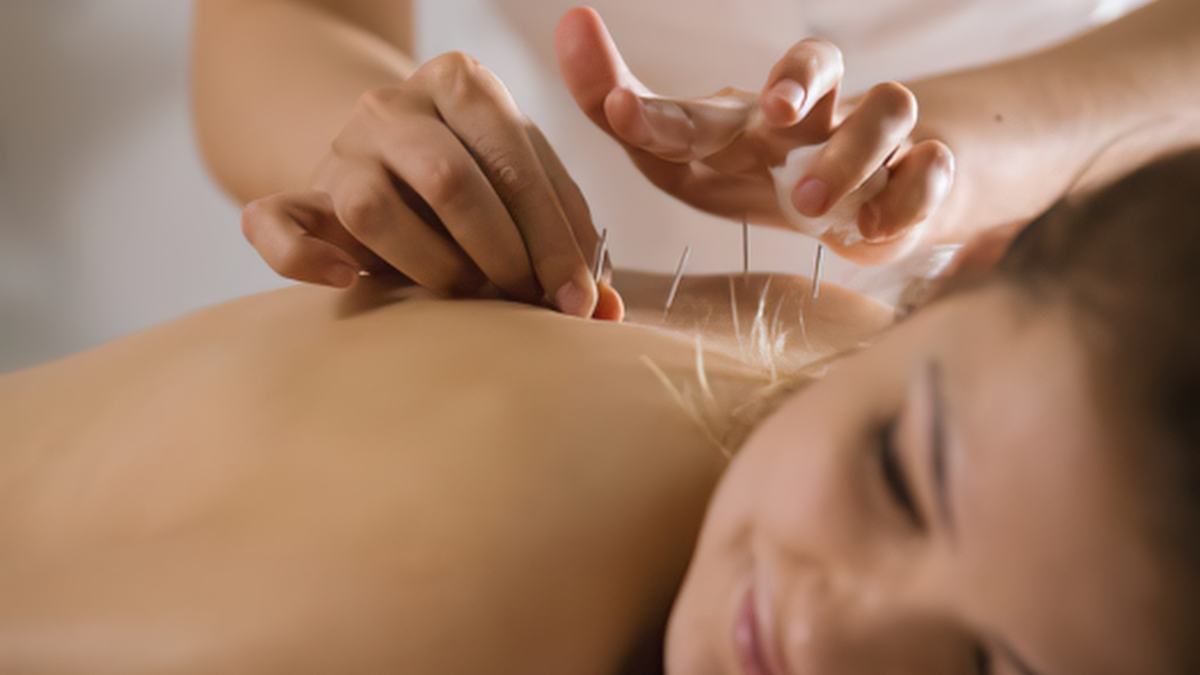 A young white woman looking relaxed while receiving acupuncture