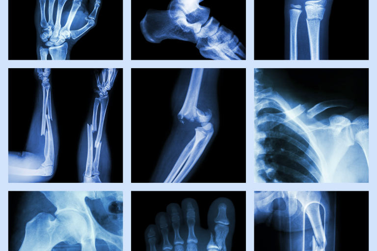 Bone scans for breast cancer testing LBBC