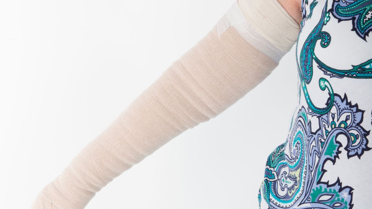 A white woman's arm in a lymphedema sleeve