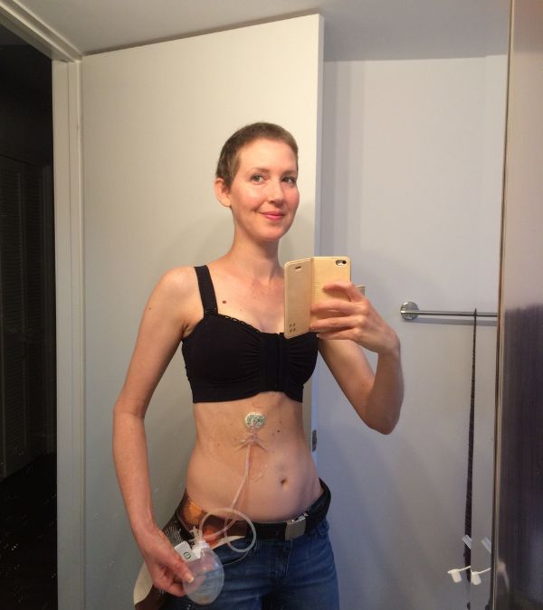 Bethany Adair takes a selfie in a supportive black bra showing her drain.