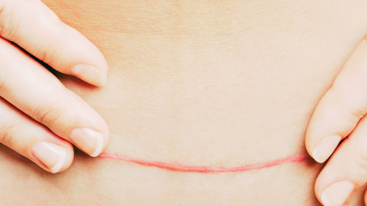 Woman's hands lightly touch the sides of an abdominal scar.