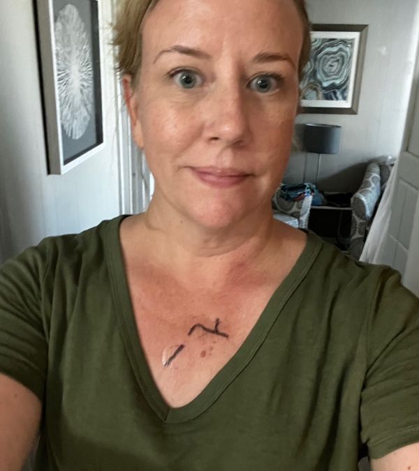 Kendra Ajuba shows us how her green v-neck exposes her radiation marks.