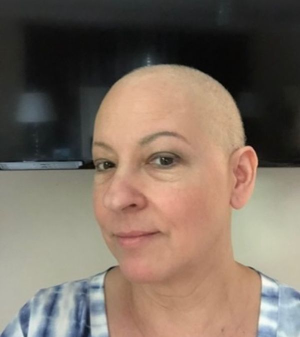 Maria Lleonart sees a little regrowth on her scalp now that she has completed chemotherapy.