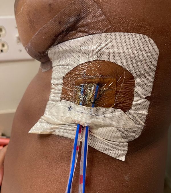 A close-up of drains on Nikki Taylor's chest.