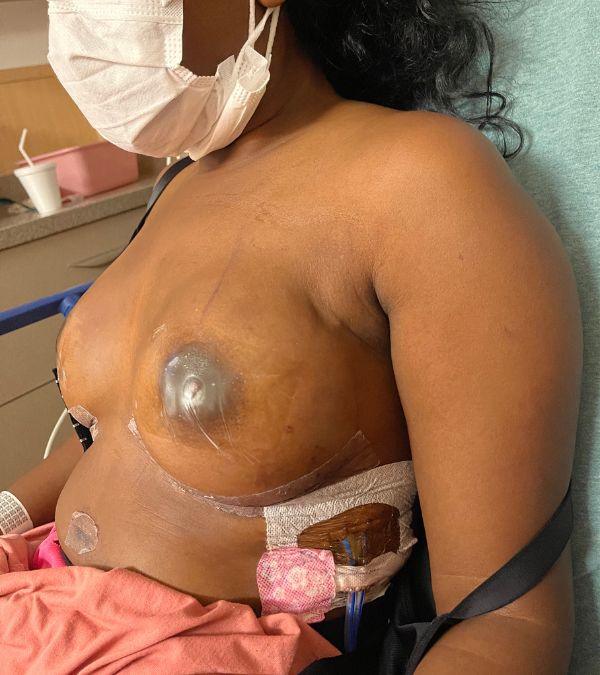 Nikki Taylor demonstrates her post-surgery chest, incisions and drains clearly visible.