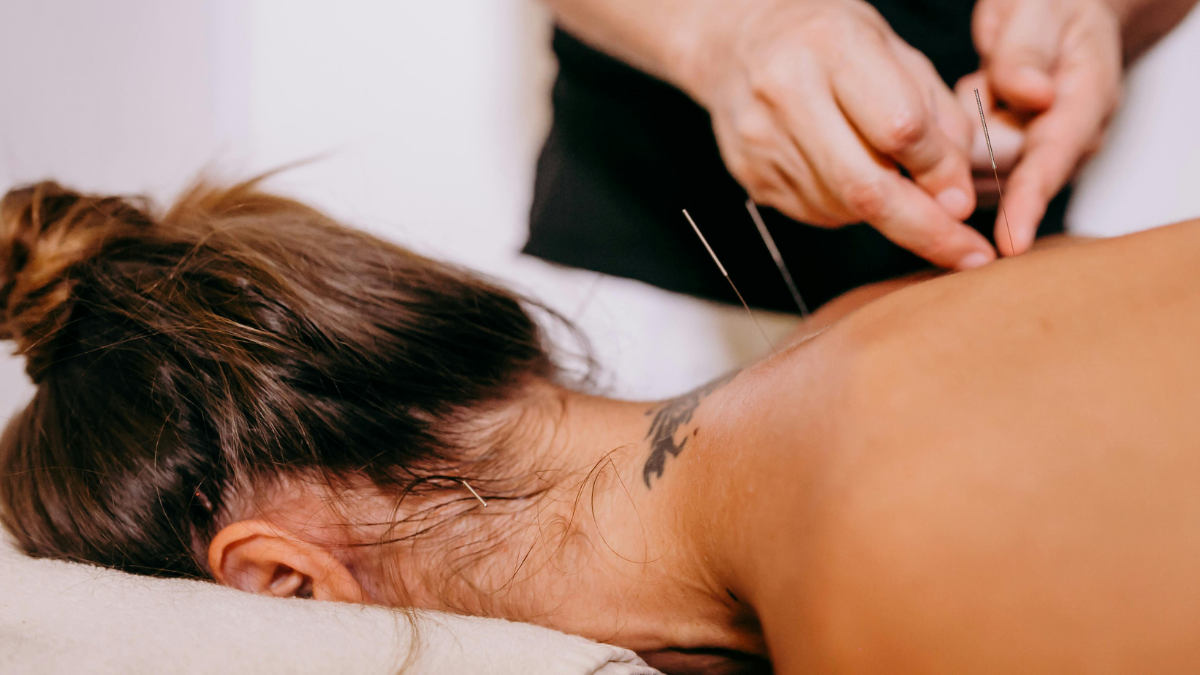 A woman lying face-down receiving acupuncture treatment to her back.